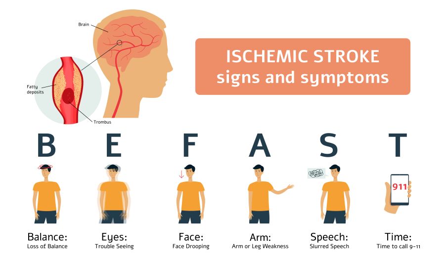ischemic stroke symptoms