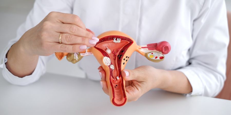 Uterine fibroids